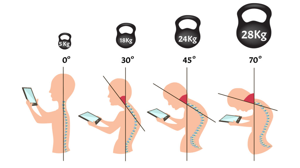 Types Of Posture Types Of Postural Deformities MFine