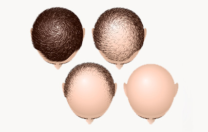 hair loss in men 2 mfine