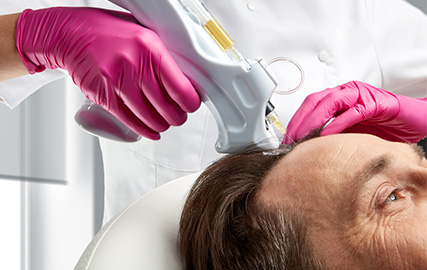 hair loss in men 4 mfine