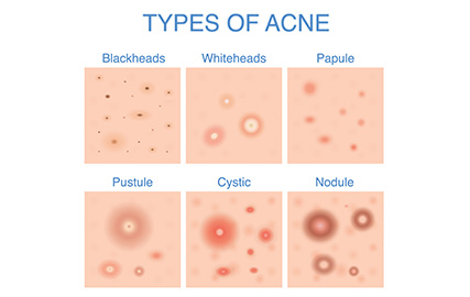 Don't Stress! Treat Acne the Right Way | mfine