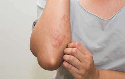 rashes due to milk allergy mfine 