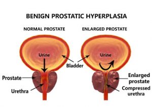 All You Need To Know About Prostate Enlargement | mfine