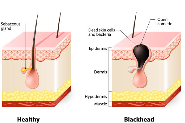 how blackheads are formed mfine 