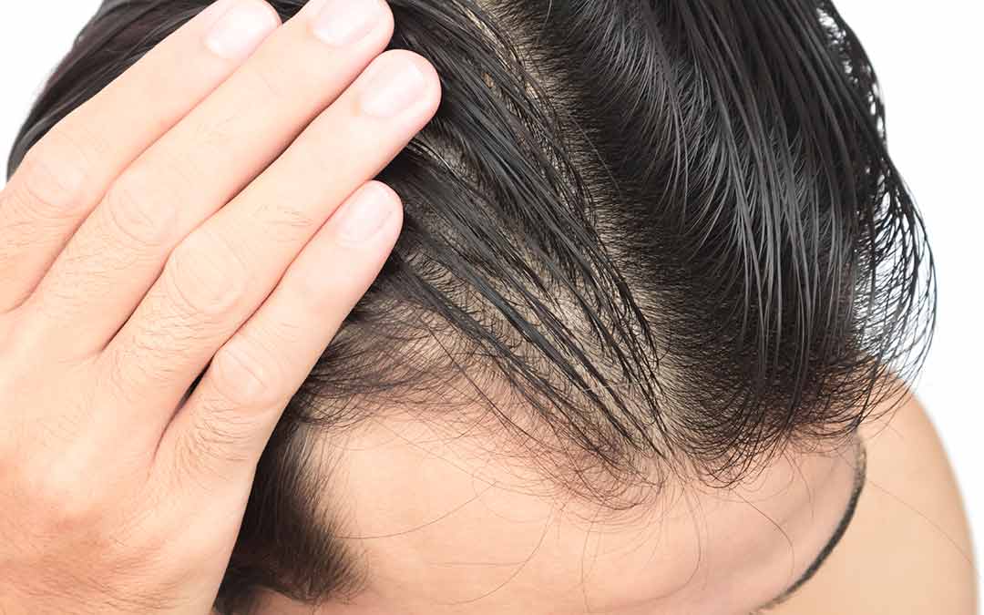 Why Should You Take The Hair Loss Panel?