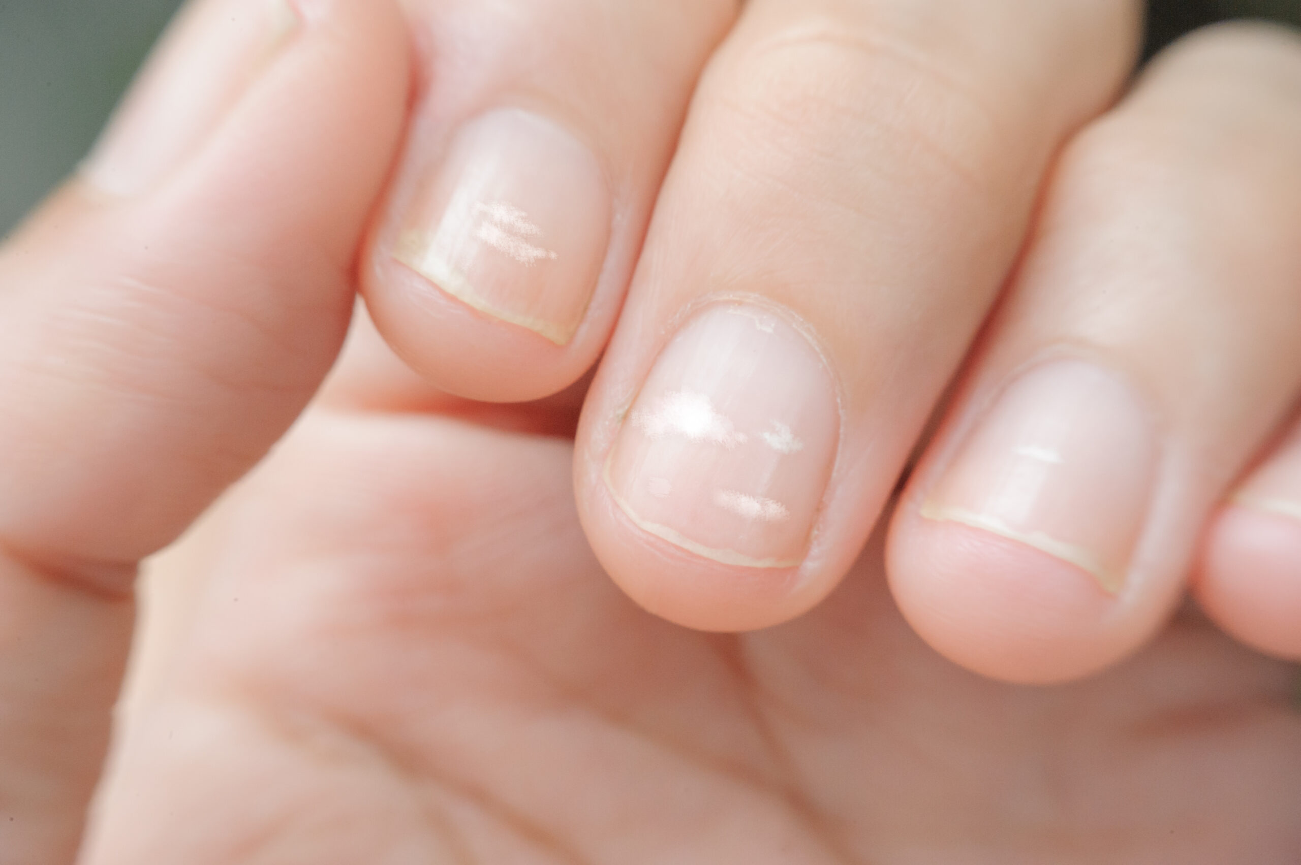 Blue Nails Disease: Causes, Symptoms, and More - HealthKart