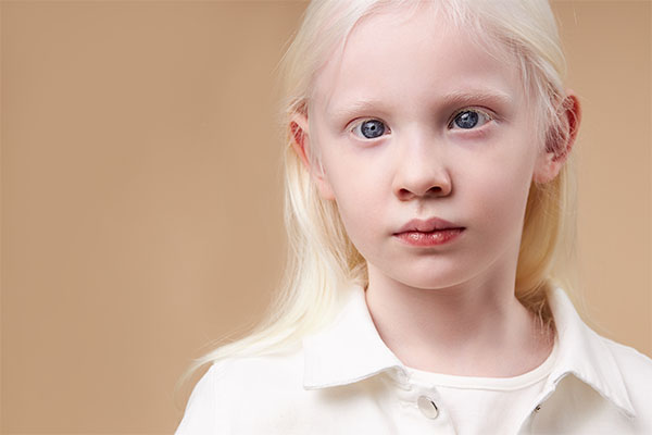 albinism eye problems