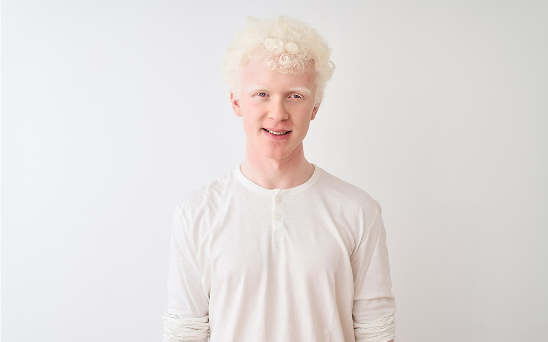 Symptoms, Causes, and Treatment of Albinism