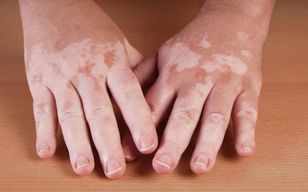 Vitiligo: Fighting The Stigma Around This Skin Condition