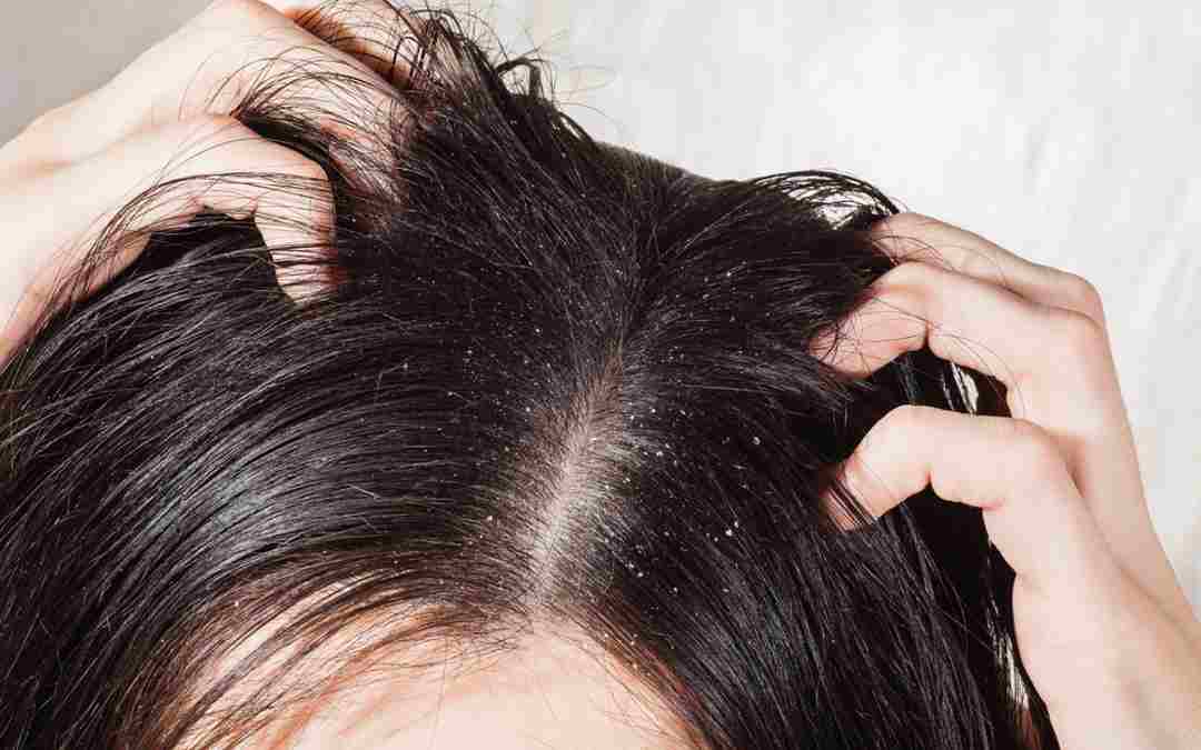 Dandruff Treatment: Ditch The Itch & The Flake