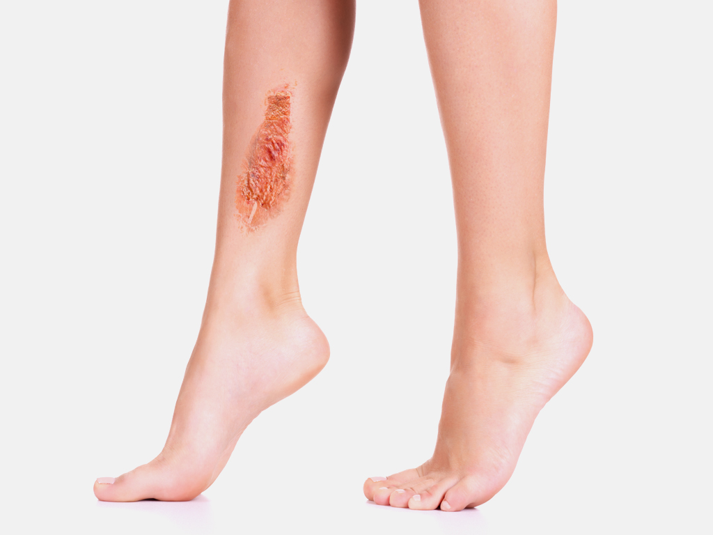 Venous Stasis Ulcer Treatment Pictures Causes Symptoms