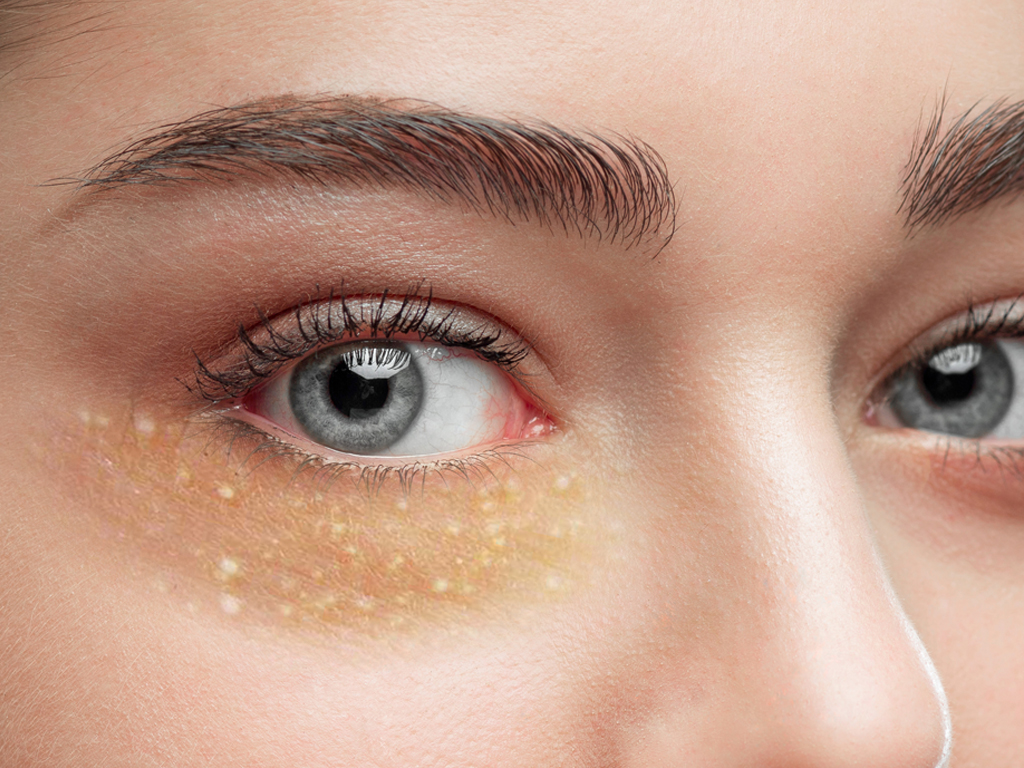 Yellow Patches On Skin Under Eyes At Jennifer Hernandez Blog