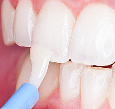 Fluoride treatment for Dental caries