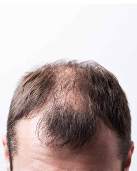 Diffuse Unpatterned Alopecia in Indians: Causes & Treatments