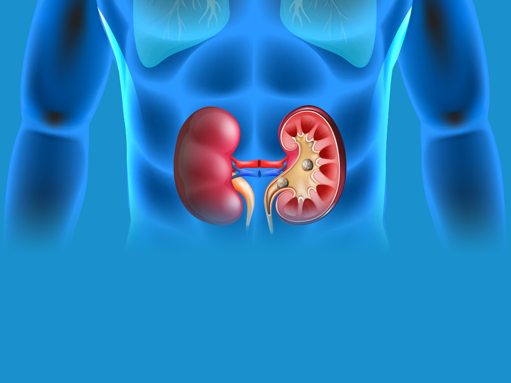 non obstructive left renal calculus