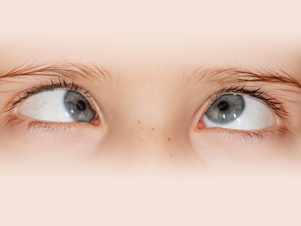 Reason for Squint Eyes in Indian Children | Diagnosis & Treatment | MFine