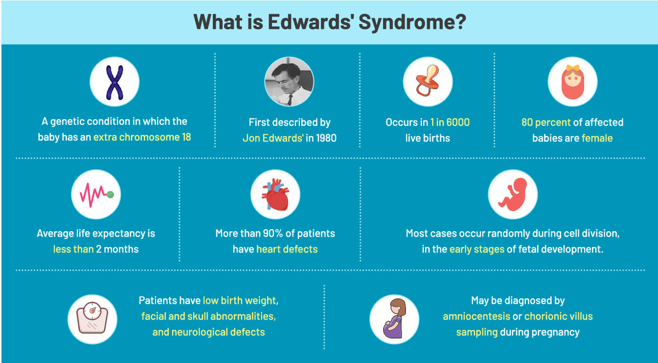 what-is-edwards-syndrome