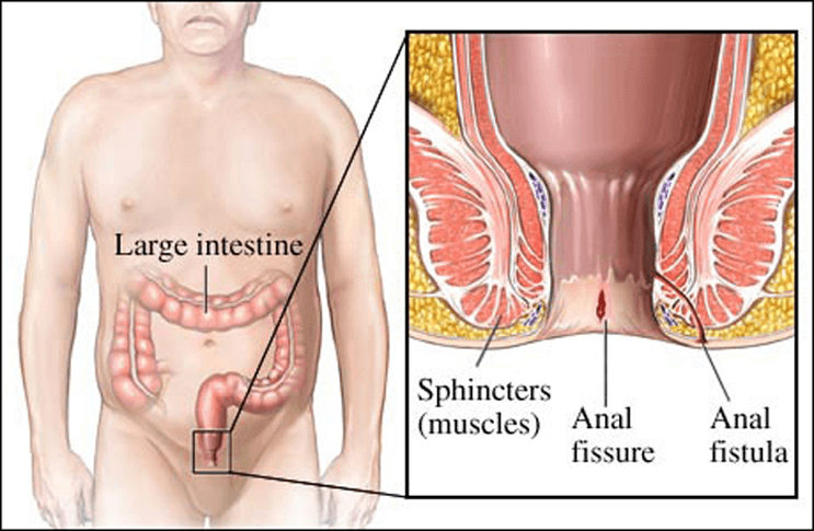 difference between piles and fistula