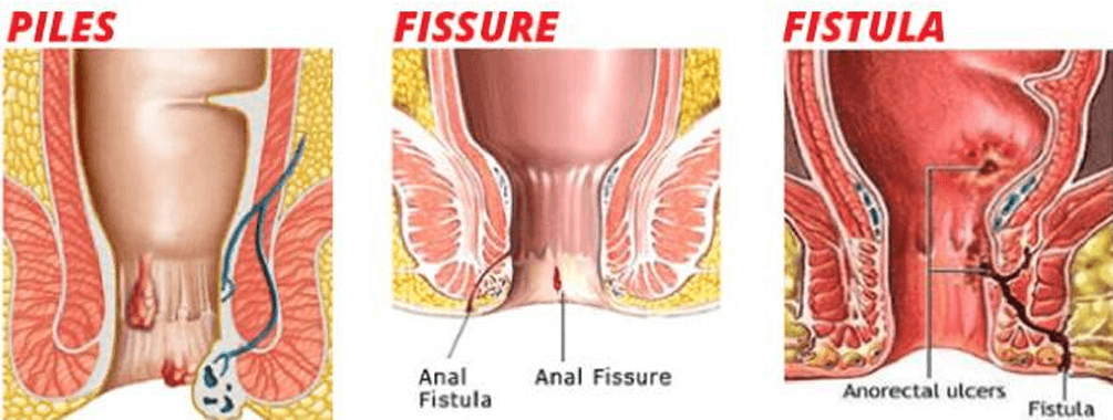 difference between piles and fistula