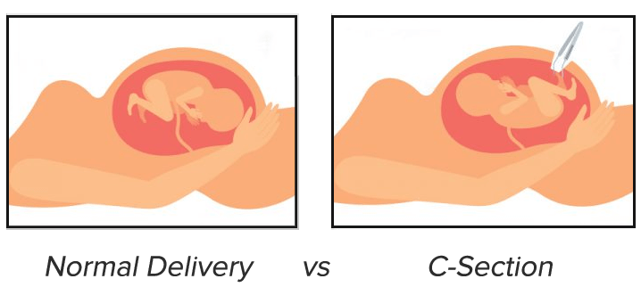 Normal Delivery Vs C Section