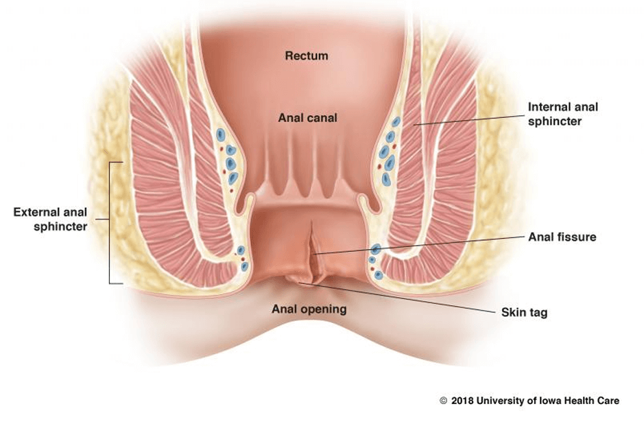 A fissure vaginal is what Vaginal cuts