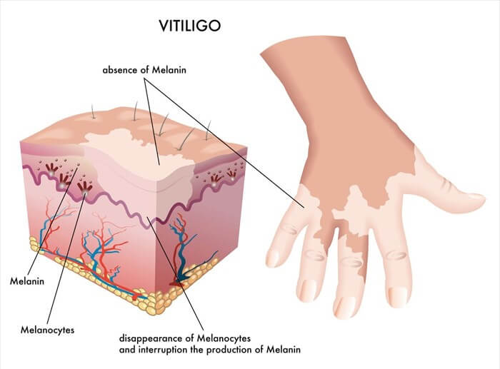 is vitiligo contagious