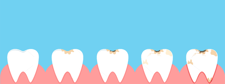 Dental caries - symptoms of dental caries
