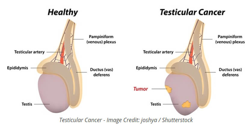 testicular cancer treatment