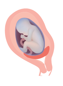 low lying placenta