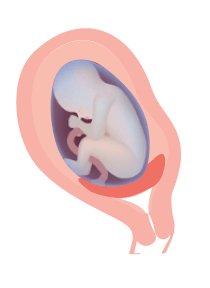 pelvic rest for low lying placenta