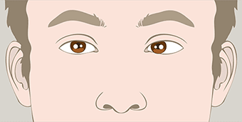 Squint Eyes in children MFine - Esotropia
