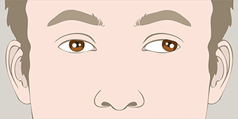 Squint Eyes in children MFine - Esotropia