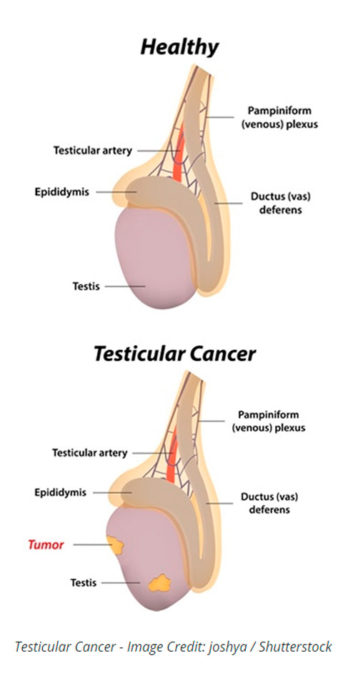 testicular cancer treatment