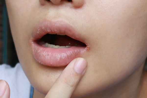 winter skin problems mfine - chapped lips