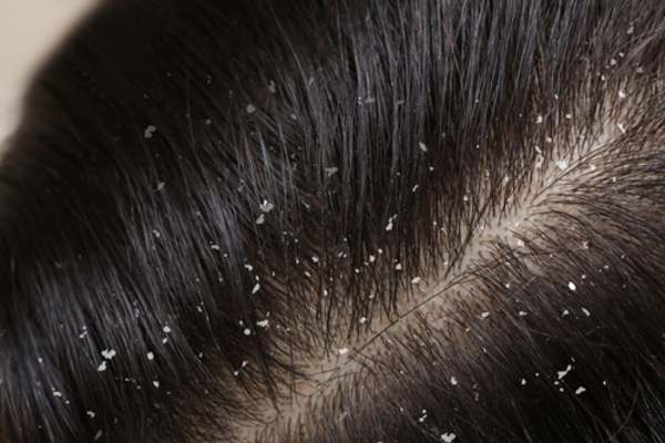 winter skin problems mfine - dandruff in hair