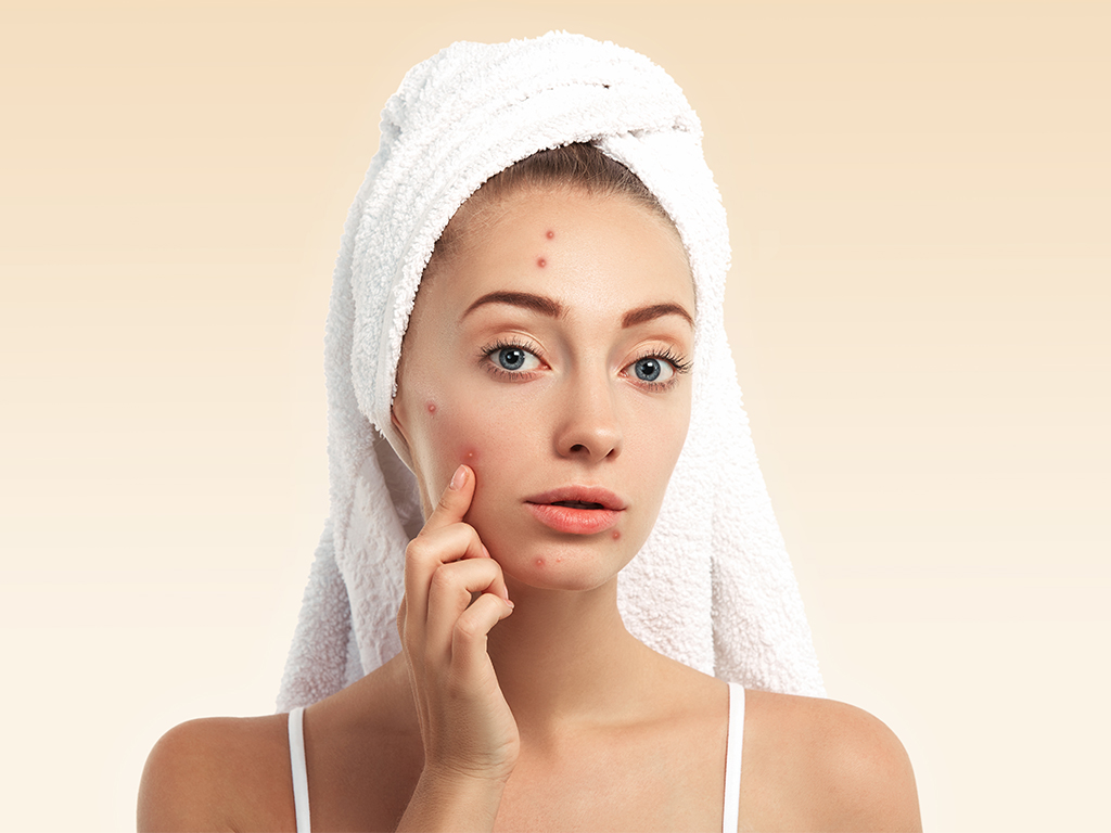 Acne Problem: Symptoms, Causes & Treatment | MFine