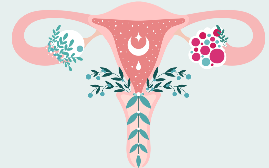 PCOS and Irregular Periods: How Long Can Periods Be Delayed?
