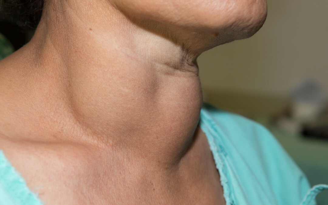 How To Shrink A Goiter Naturally: Effective Home Remedies And Tips