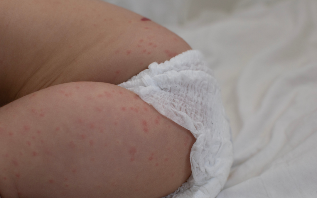 Diaper Rashes Home Remedies: 10 Important Tips