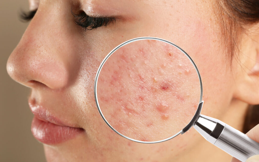 hormonal acne