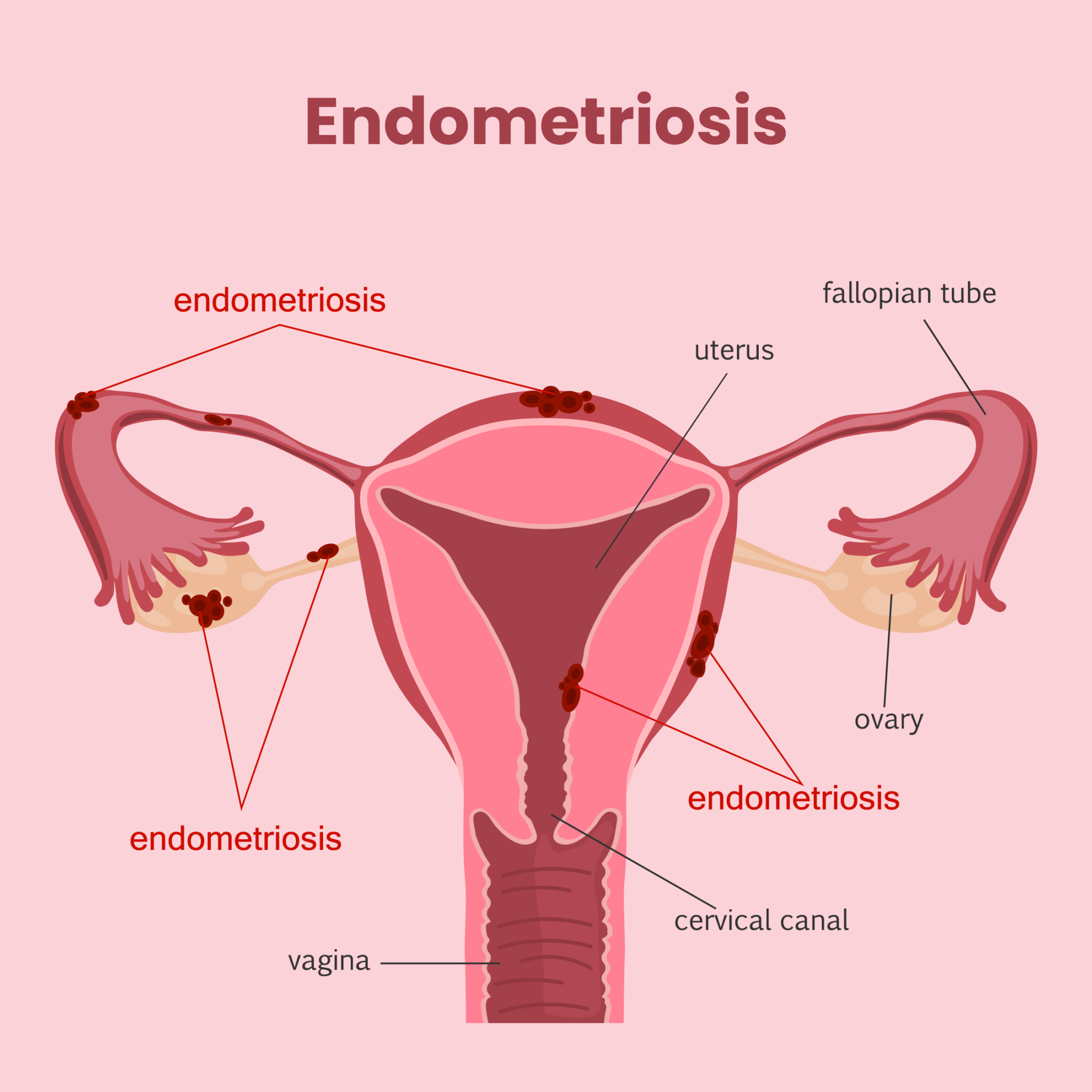 The Causes, Symptoms, Diagnosis, & Treatment Of Endometriosis MFine
