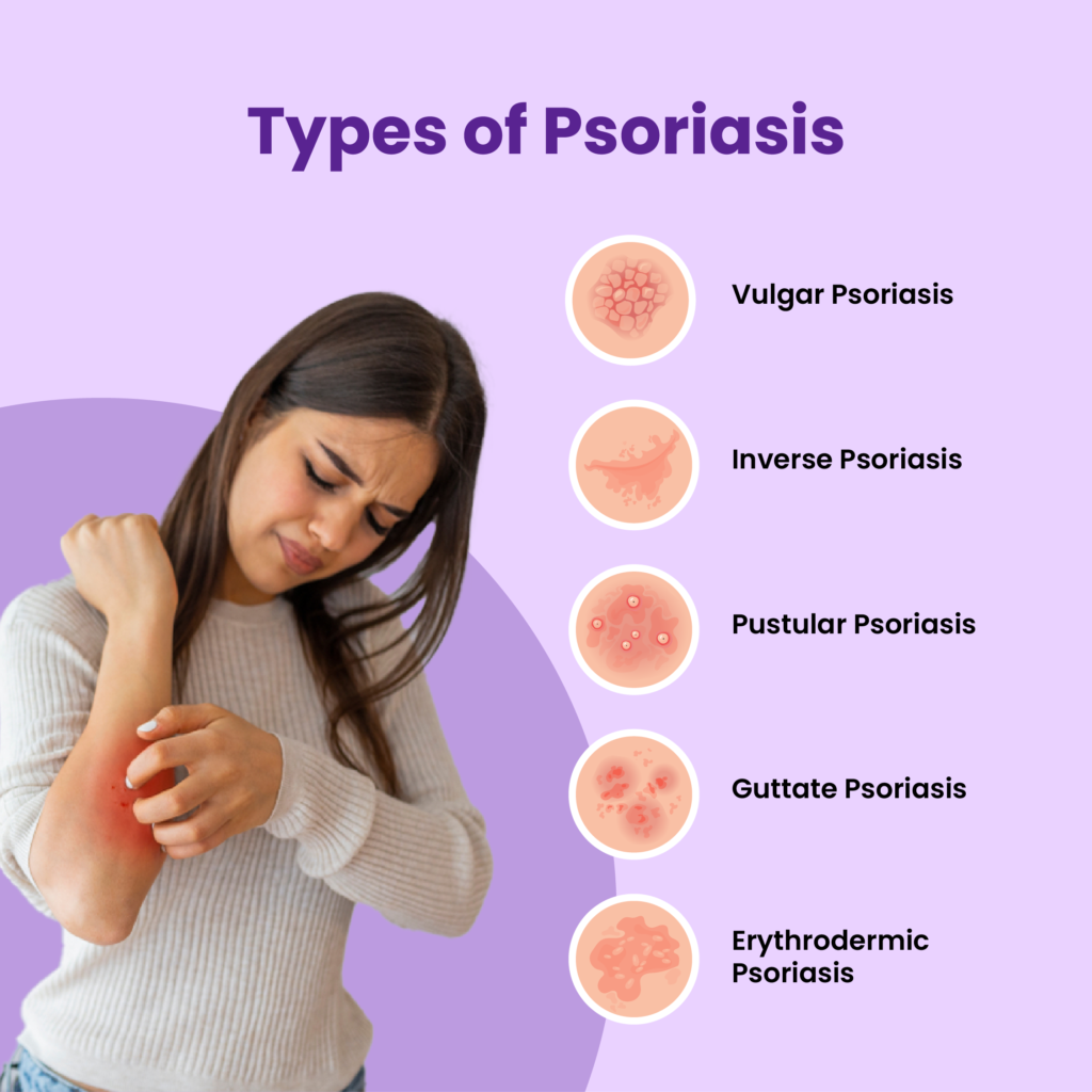 What Is Psoriasis: Symptoms, Diagnosis, Causes & Treatment - MFine