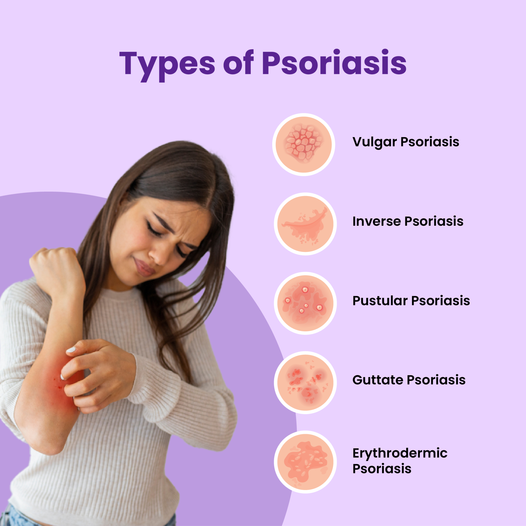 What Is Psoriasis: Symptoms, Diagnosis, Causes & Treatment - Mfine