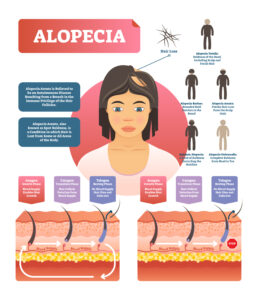 how to stop alopecia areata from spreading