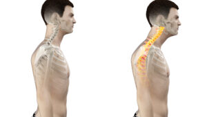 types of posture-forward head