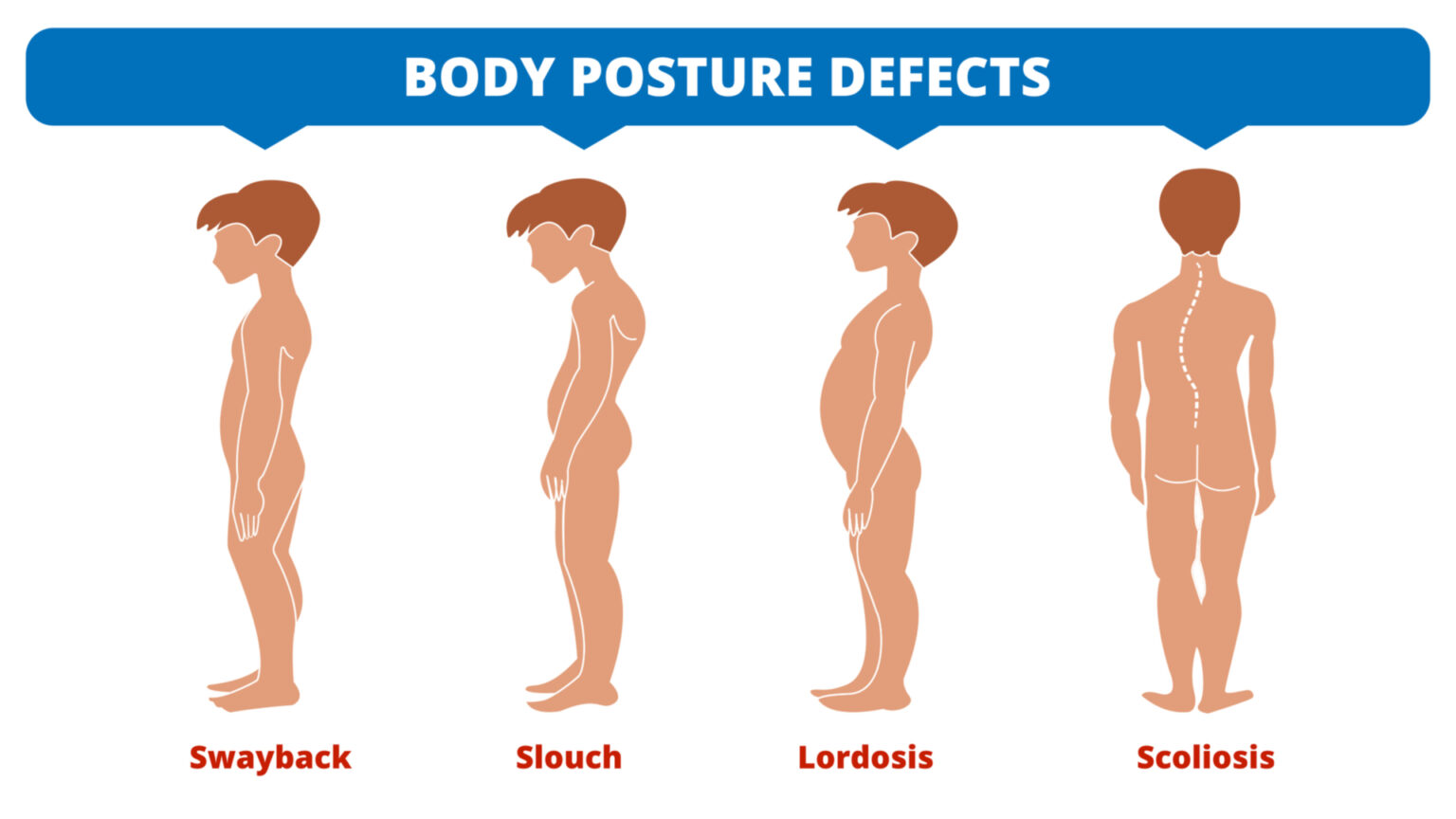 Stoopingly Types of Posture & Postural Deformities | Expert Guide