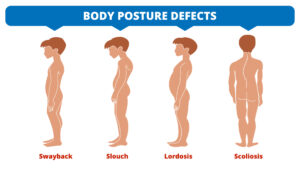 types of bad posture