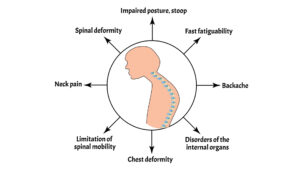 types of posture-kyphosis