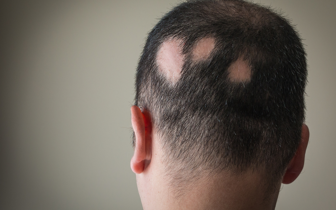 All About Alopecia Areata Explained