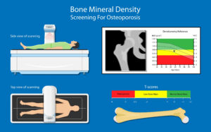 bone mineral density test