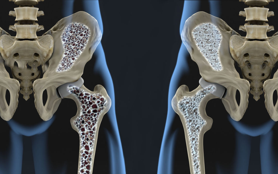 Do vegans have lower bone mineral density and a higher risk for osteoporosis?